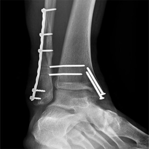 X-Ray